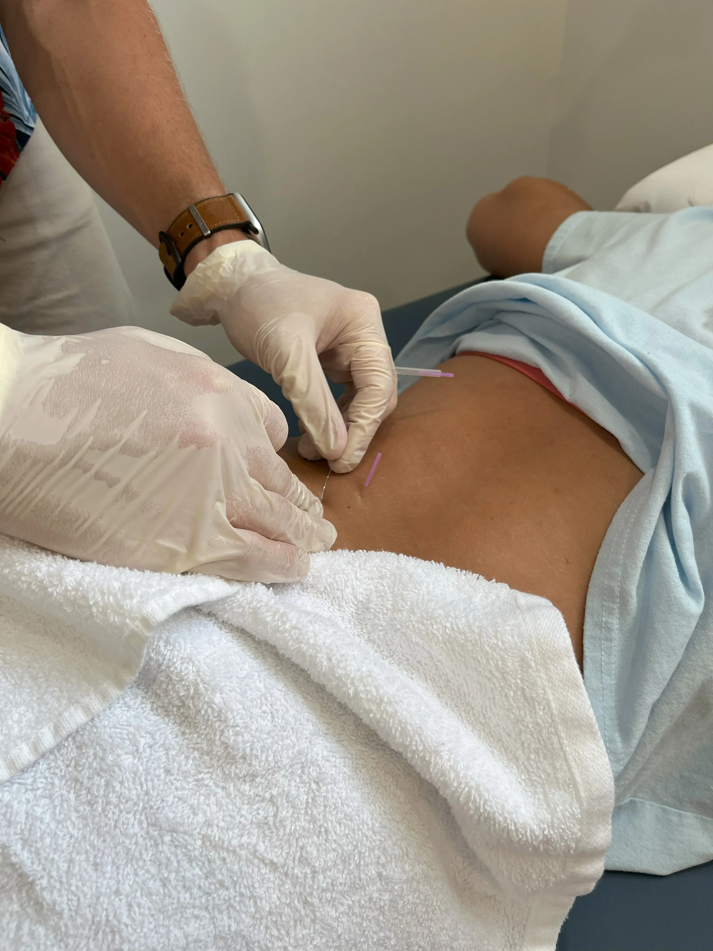 Dry Needling